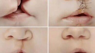 Riobamba realizará cirugías gratuitas de labio leporino en marzo ...