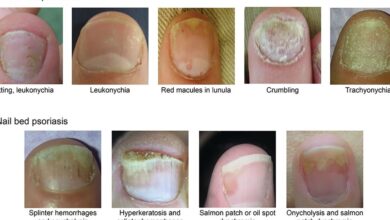 Nail Psoriasis: Diagnosis, Assessment, Treatment Options, and Unmet ...